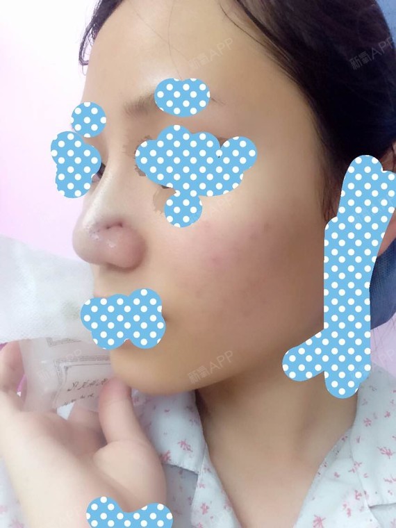 今天下定决心动手术了,做的是鼻翼沟没有做缩小鼻头,加上鼻子打玻尿酸