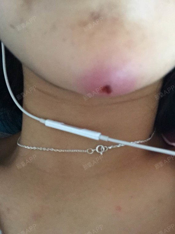 新氧- 缅甸太皇后渣咕噜葫 | 术后当自强 | 玻尿酸隆鼻