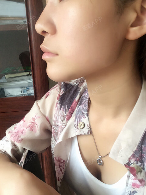 新氧- 让生命美美哒 | 下巴 | 硅胶垫下巴 | 术后当自强