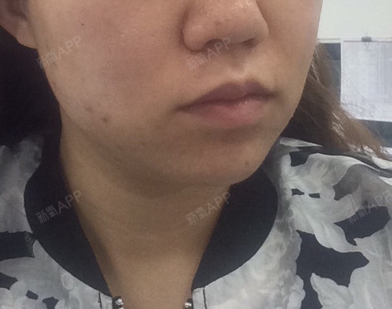 一边比另一边肿的严重,而且咬肌酸酸的,很难受,不舒_圈子-新氧美容