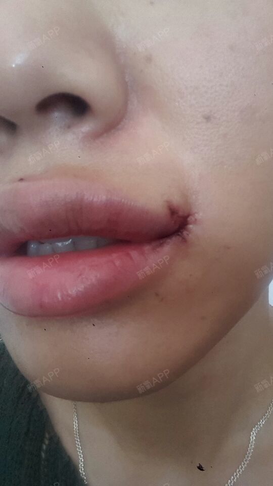 早就有宝贝们询问嘴角上扬手术smilelips,能不能做?