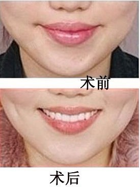 酒窝整形酒窝指的是做出面部表情时或者微笑的时候在两_圈子-新氧美容