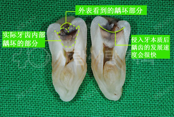 牙釉质龋的病理分层图图片