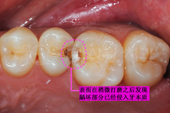 小小的齒間齲齒,毀了兩顆牙