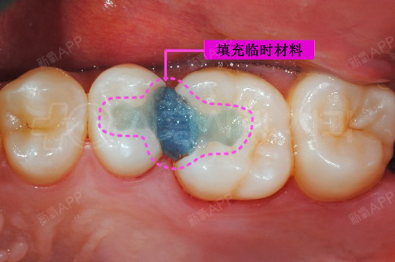 小小的齿间龋齿,毁了两颗牙