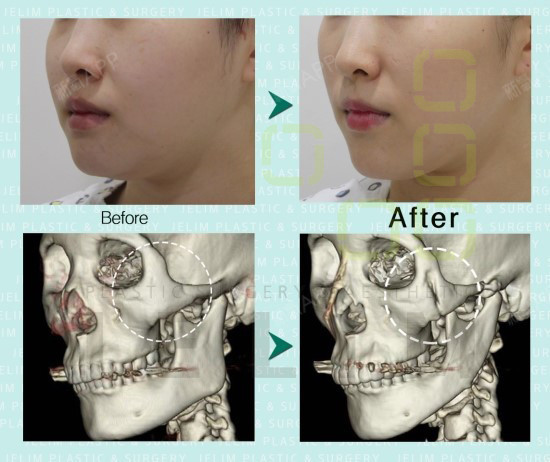 【jelim整形外科】安全的颧骨修复手术