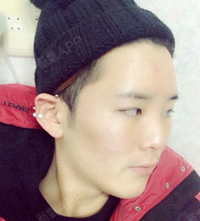 手术之前抬头纹比较严重,眉骨也属于比较高的