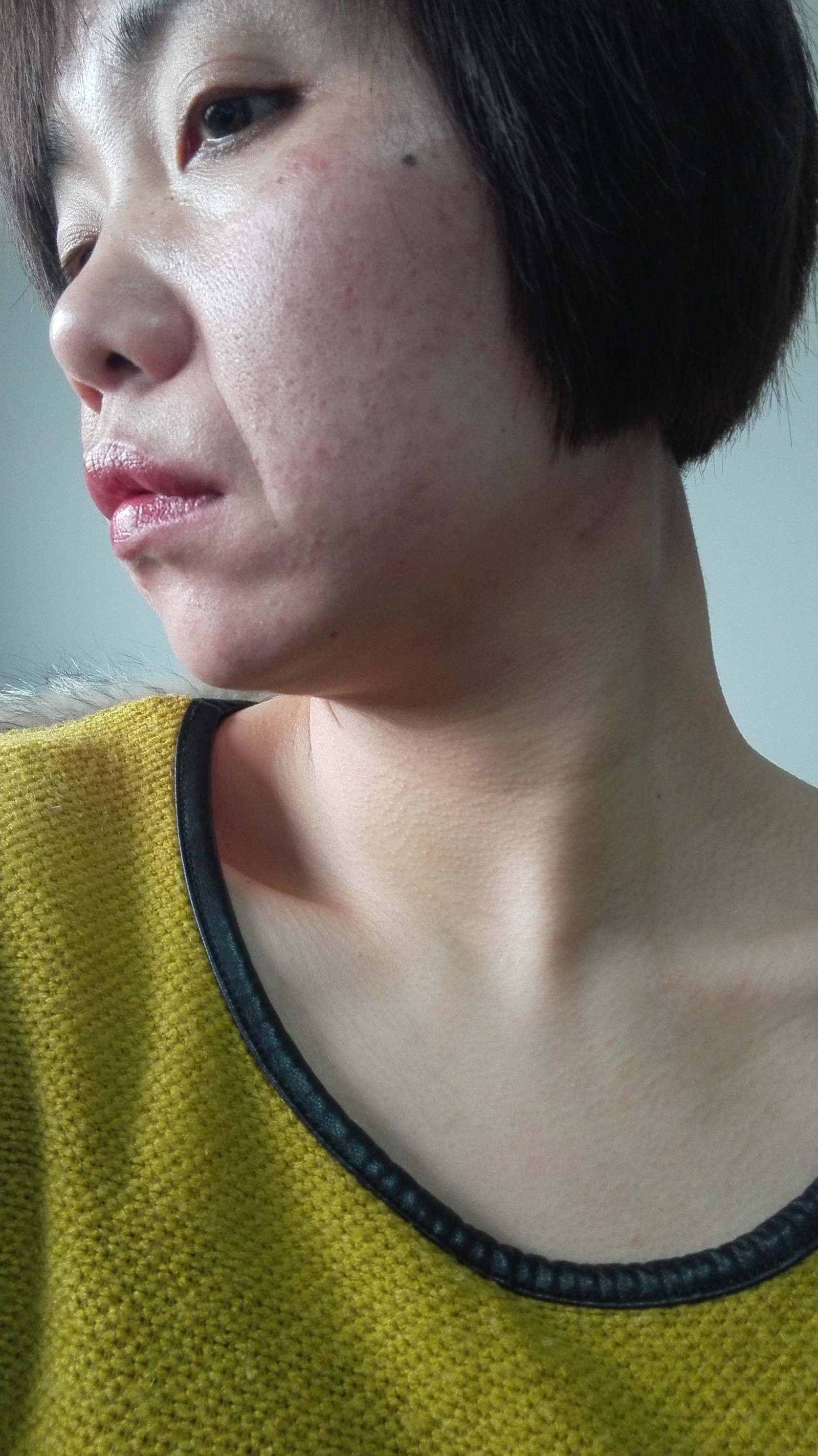 半边脸面瘫的原因