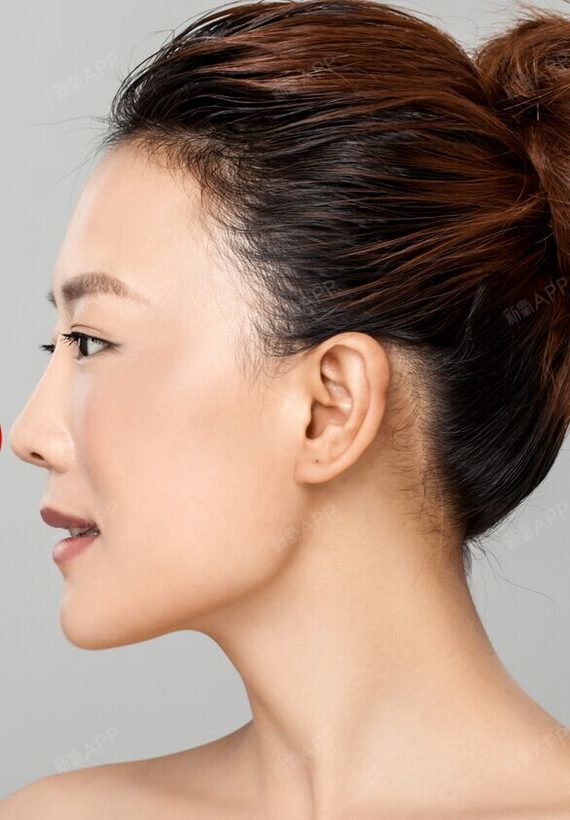 深圳米兰柏羽医学美容医院玻尿酸隆鼻第41天美丽日记