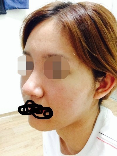 罗马酱自体软骨垫鼻尖第28天美丽日记