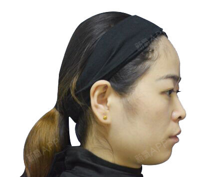 我的下巴真的很短所以整个脸看上去就比较圆更别说什么_圈子-新氧美容